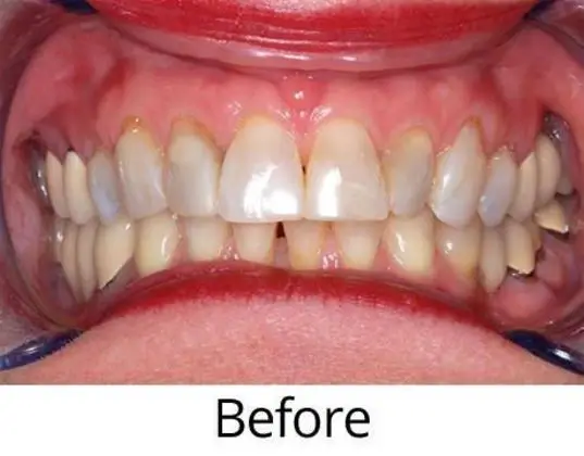dental-crowns-001-b