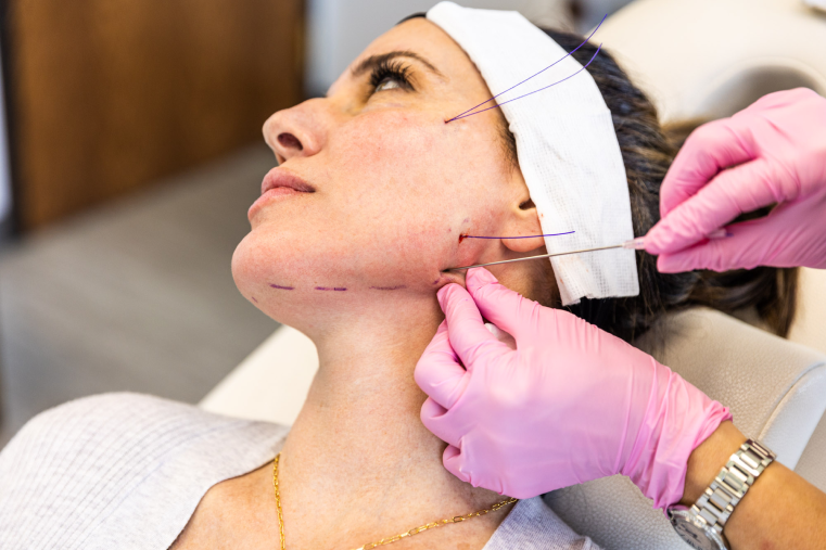 A woman lays on her back, her face turned to the side, as Dr. Kleinheinz inserts PDO threads as part of a plan for her facial aesthetics in Charlotte.