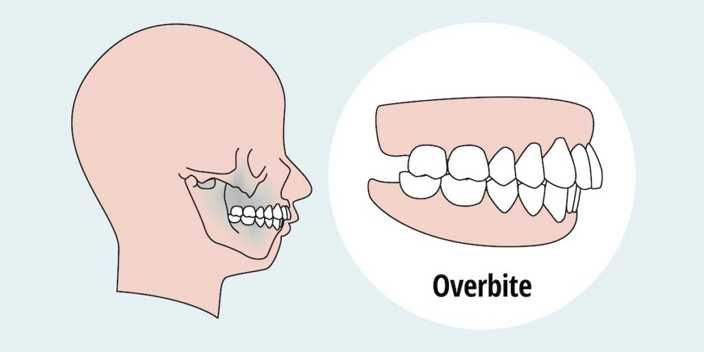 Graphic presentation of what an overbite looks like. This is the type of dental concern that could benefit from overbite treatment in Charlotte.